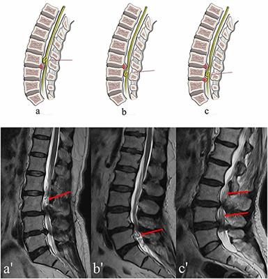 Clinical Features and Efficacy Analysis of Redundant Nerve Roots